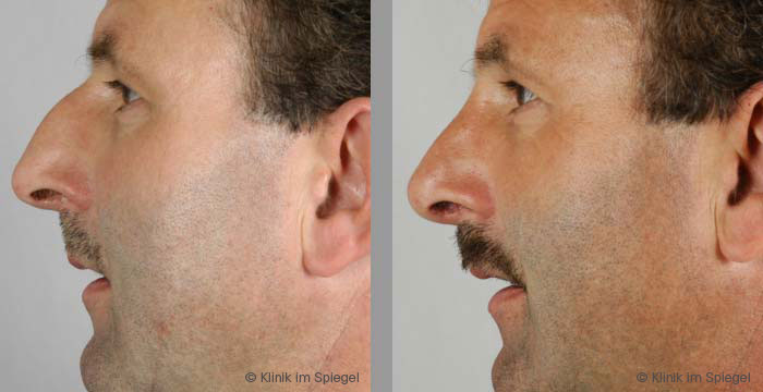 Männer nachher nasen vorher op chauglophdisling: Nasen